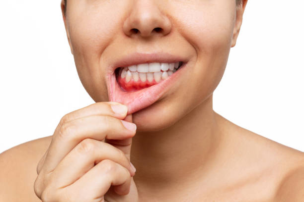Bleeding gums treatment near you
