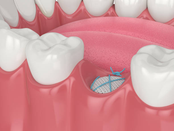 Bone grafting near you