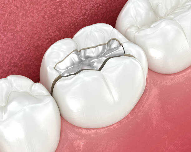 Chipped tooth treatment near you