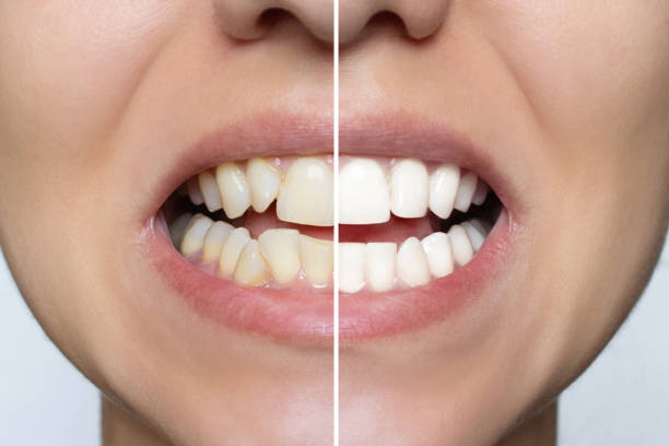 Crooked teeth treatment near you