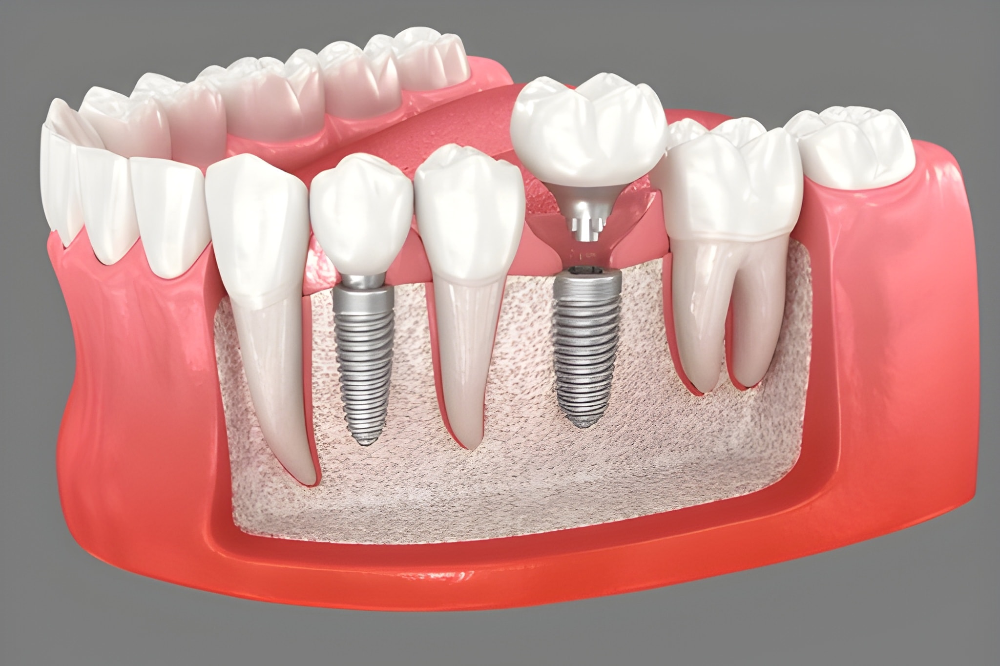 Dental implants near you