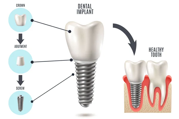 Why Dental Implants Prevent Future Oral Health Problems