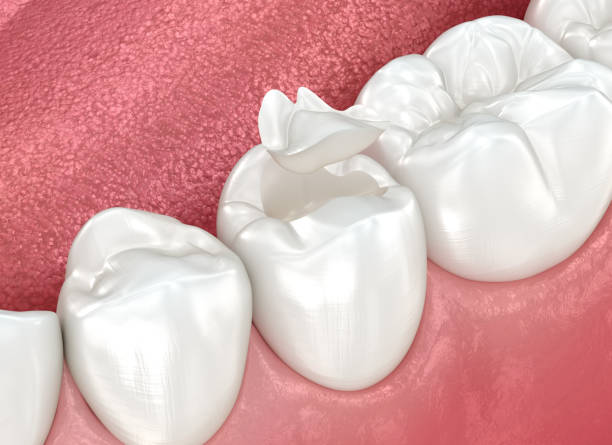 Dental sealants near you