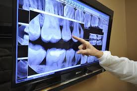 Digital dental x rays