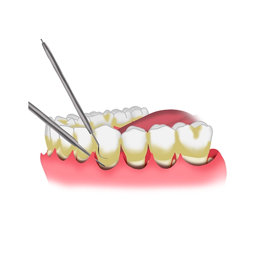 Periodontal flap surgery near you